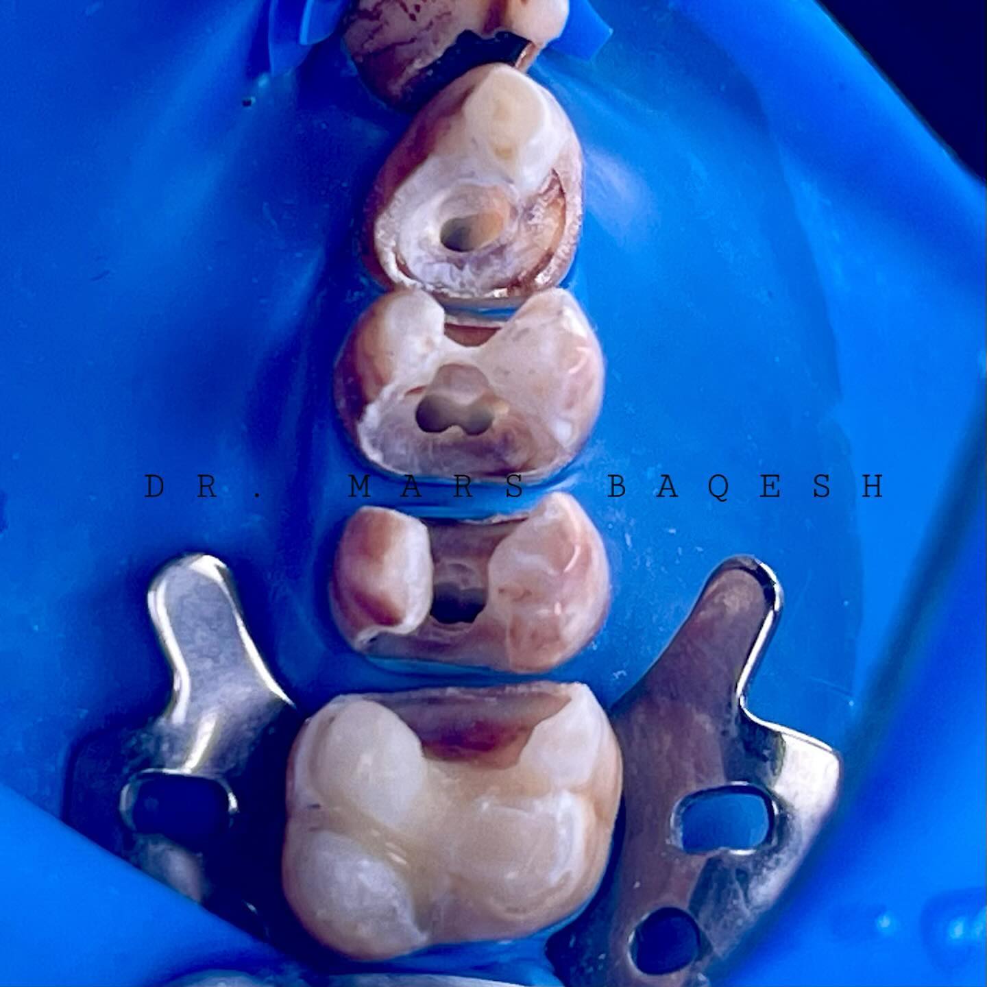 Root Canal Treatment